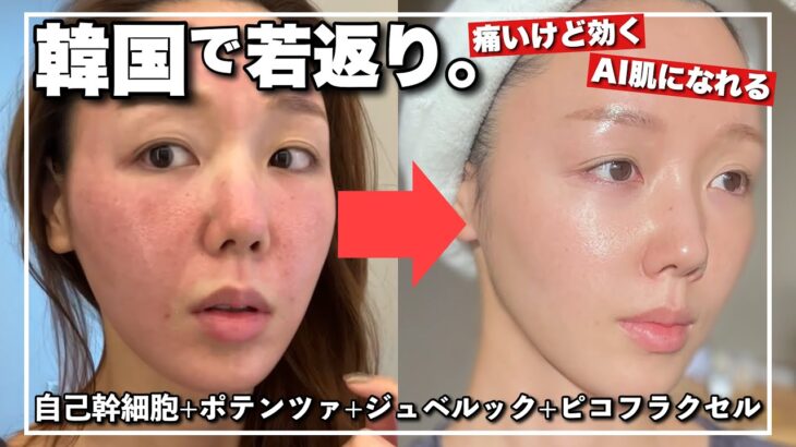 【韓国旅行vlog🇰🇷】アンチエイジング🔥衝撃ビフォーアフター㊙️自己幹細胞×ポテンツァ×ジュベルック✨【激痛⁉️】