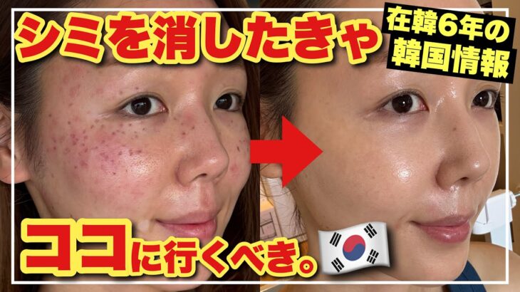 【韓国旅行シミ取り完全ガイド】チョンダムジェイクリニックでレーザー治療してみた結果がコレ【韓国美容皮膚科の無加工&リアルレポ】